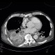 Pneumonia, panlobular emphysema, fluid-filled bullae: CT - Computed tomography
